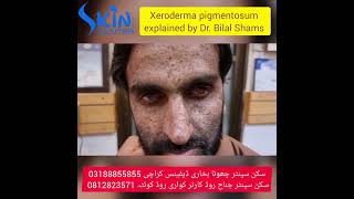 Xeroderma pigmentosum  skin cancer  best dermatologist  Dr Syed Bilal Shams skincenterpakistan [upl. by Htide]