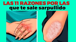 11 razones por las que te sale sarpullido o ronchas en el cuerpo [upl. by Notled376]