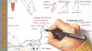 Multiple Sclerosis MS  Causes Pathophysiology Signs and symptoms Diagnosis Management [upl. by Hobart]