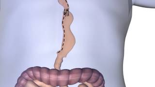 Esophagectomy Procedure Animation [upl. by Anuaek]