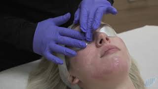 Reignite a bright even skin tone with Intense Pulsed Light IPL [upl. by Anelej]