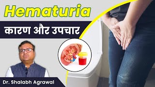 ❇️पेशाब में खून आने का कारण  What is Hematuria 🔰Blood in Urine Hematuria Symptoms And Treatment [upl. by Mulloy]