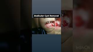 Radicular cyst removal in 6yrs old child [upl. by Ranee729]