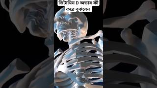 কি কি লক্ষণ দেখে বুঝবেন ভিটামিন D এর ঘাটতি আছে Vitamin D deficiency BoneHealth [upl. by Silvestro]