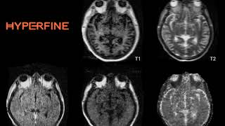 COVID19 Watershed Stroke Patient [upl. by Langdon]