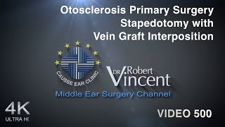 Otosclerosis Primary Surgery Stapedotomy with Vein Graft Interposition [upl. by Ennobe614]