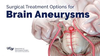 Surgical Treatment Options for Brain Aneurysms [upl. by Acemahs924]