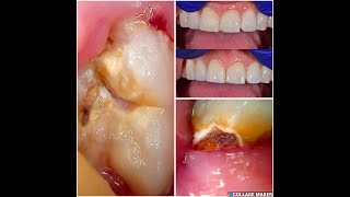 62 Chipped front tooth repair and wisdom teeth extractions [upl. by Atalante879]