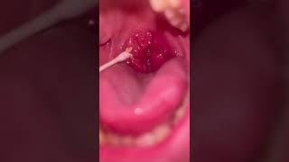 tonsil stones removal1 [upl. by Einapets763]