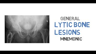 What are the differentials for lytic bone lesions [upl. by Rollet992]