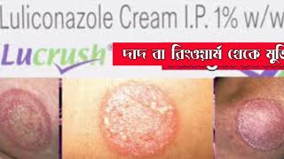 Ringworm treatment  দাদ  Luliconazole cream medinfobengali [upl. by Ehtnax]