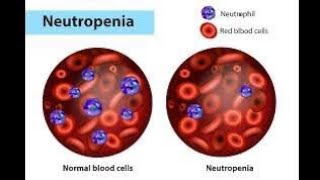 NEUTROPENIA  Definition of neutropenia  Causes of neutropenia [upl. by Dennis]