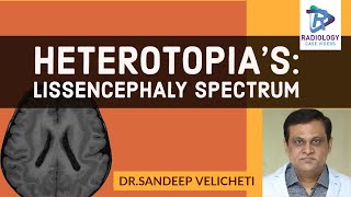 HeterotopiasLissencephaly SpectrumSandeep velichetiLissencephaly spectrum type 1 part2ped neuro [upl. by Esilrahc]