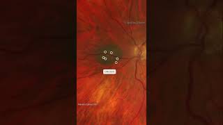 Multimodal analysis in a case of Choroidal nevus Visit wwwretinographyorg for more retina [upl. by Chak]