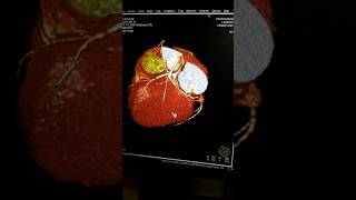 Coronary artery  medicalstudentprocessing ctscan radiology angiography medicalstudent [upl. by Atiran]