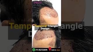 Incredible 3000 Advanced FUE Grafts Hair Transplant at Medispa Clinic By Dr Suneet Soni [upl. by Manthei]