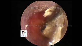 Ear wax removalfungus in ear cleaning20230223 [upl. by Anahsed932]