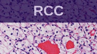 Renal Cell Carcinoma  Pathology mini tutorial [upl. by Ineslta]