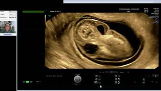 CYSTIC HYGROMA  HYDROPS FETALIS Dr Wiku Andonotopo [upl. by Jerrine]