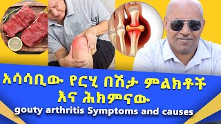 አሳሳቢው የ ርሂ በሽታ ምልክቶች እና ሕክምናው Uric Acid  gouty arthritis Symptoms and causes [upl. by Lyndsie]