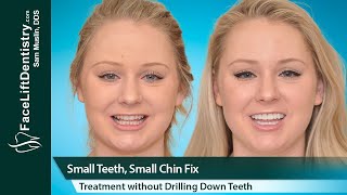 Small Teeth Chin Overbite Fix No Drill No Clear Aligners [upl. by Ataeb]