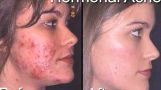 acne before after [upl. by Yonatan181]