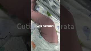 Cutis marmoratanewborn paeds clinical [upl. by Phebe130]