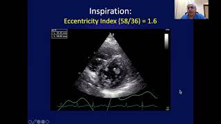 Haemodynamics by echo Doppler in HFpEF [upl. by Dupuy]