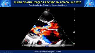 Iniciando o estudo de um insuficiência mitral e insuficiência aórtica [upl. by Heurlin]