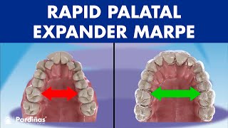 Rapid PALATAL expander MARPE  This ORTHODONTIC device can EXPAND the PALATE in adults© [upl. by Noy]