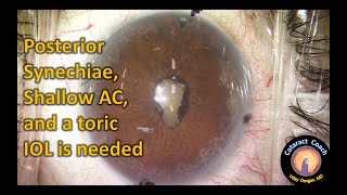 Cataract Surgery with Lysis of Posterior Synechiae and Pupil Restoration [upl. by Yrocaj]