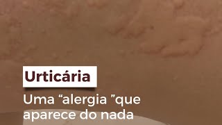 Urticária uma “alergia” que aparece do nada [upl. by Eillac]