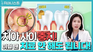 치아 사이 숨어있는 충치 인접면충치🦷 이럴 땐 치료하지 마세요 [upl. by Bussy]