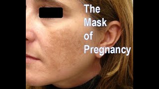 Melasma The Mask of Pregnancy Lichen Simplex Chronicus and What the Heck Is Eczema [upl. by Nylyahs]