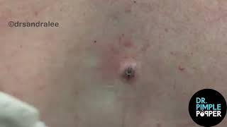 8 Minutes of Satisfying Soft Pops Dr Pimple Popper POPS All Over The Body [upl. by Ahsiemal815]