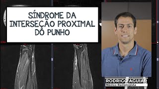 Síndrome da Interseção Proximal do Punho [upl. by Casimire]