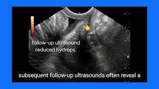 Understanding Cervical Hydrops Ultrasound Findings FollowUp Causes and Treatment Explained [upl. by Ttenaj]