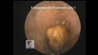 asmr ear cleaning Cerumen embolism in adults20230703 [upl. by Shimberg]