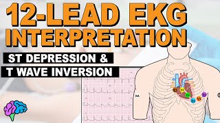 Myocardial Ischemia  ST Depression amp T Wave Inversion  12lead EKG [upl. by Kramlich]