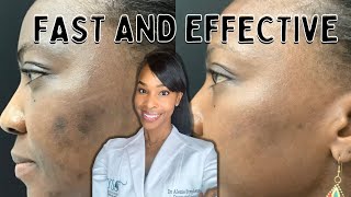 Do Chemical Peels Really Make A Difference [upl. by Aeslahc]