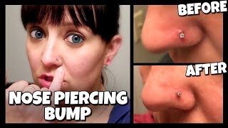 How To Get Rid Of A Nose Piercing Bump FAST  Keloid 📍 How To With Kristin [upl. by Sandon157]