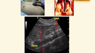 Exame USG abdomen total [upl. by Acsecnarf]