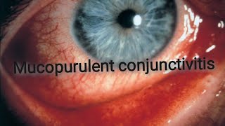 Conjunctiva  Acute bacterial conjunctivitis Part 2 [upl. by Krahmer]