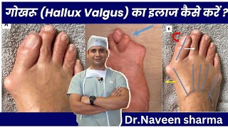 hallux valgus TREATMENT AT HOME [upl. by Blondie]