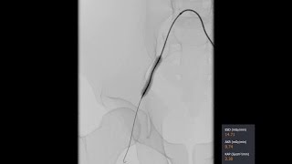 Mentice Iliac Artery Stenoses Intervention Demo [upl. by Beverle]