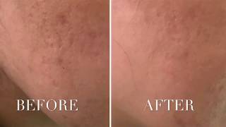 Acne Scar Treatment in Delhi video  Scar Treatment  Zolie Skin Clinic [upl. by Ailaht]