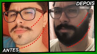 EVOLUÇÃO MINOXIDIL 1 ANO E 4 MESES Pant Foligain e Kirkland [upl. by Westberg]