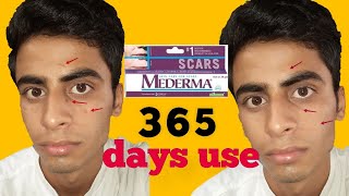 mederma cream honest review 😥 how to remove old and new scar [upl. by Winchell83]