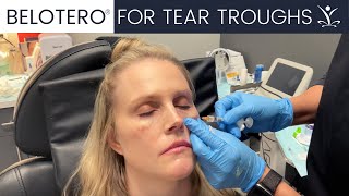 Belotero Tear Trough Filler [upl. by Lesig]