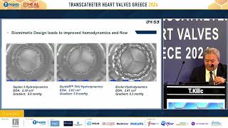 T Kilic  3 Aortic valve stenosis treatment options in young and lowrisk patients [upl. by Anitnoc511]